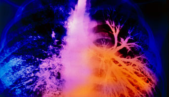 Bronchiectasis img