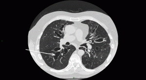 CT1 300x164