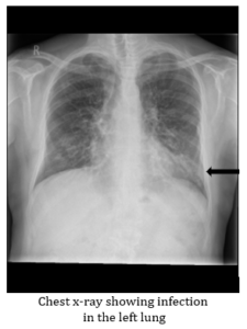Chest Infection Examples Chest infection – Bronchiectasis