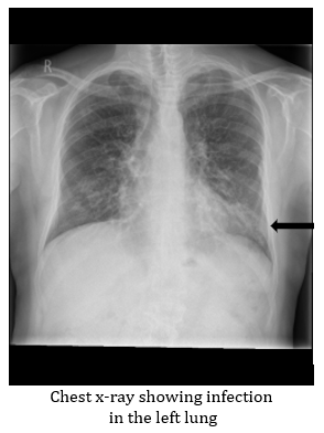Chest Infection