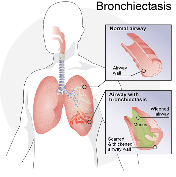 bronchiectasis medical illustration (1)
