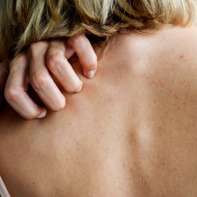 Eczema