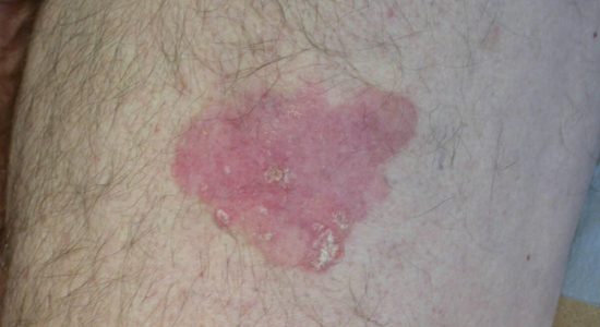 Intra-epidermal carcinoma insitu IEC (Bowen's Disease)