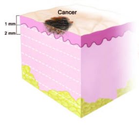Melanoma Stage 1A