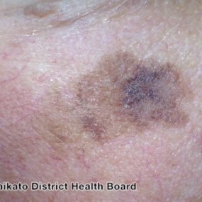 Melanoma-in-situ
