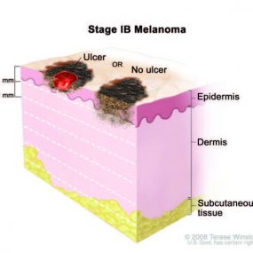 Melanoma Stage 1B