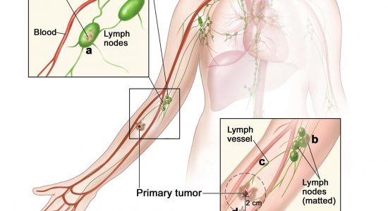 Melanoma Stage 3