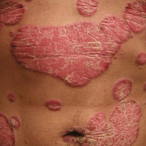 Psoriasis
