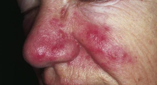 Rosacea