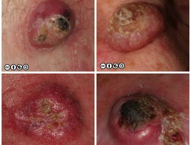 Squamous Cell Carcinoma