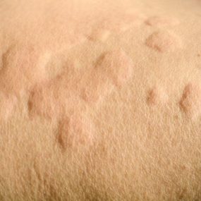 Urticaria