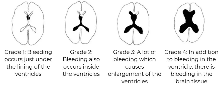 IVH Grades