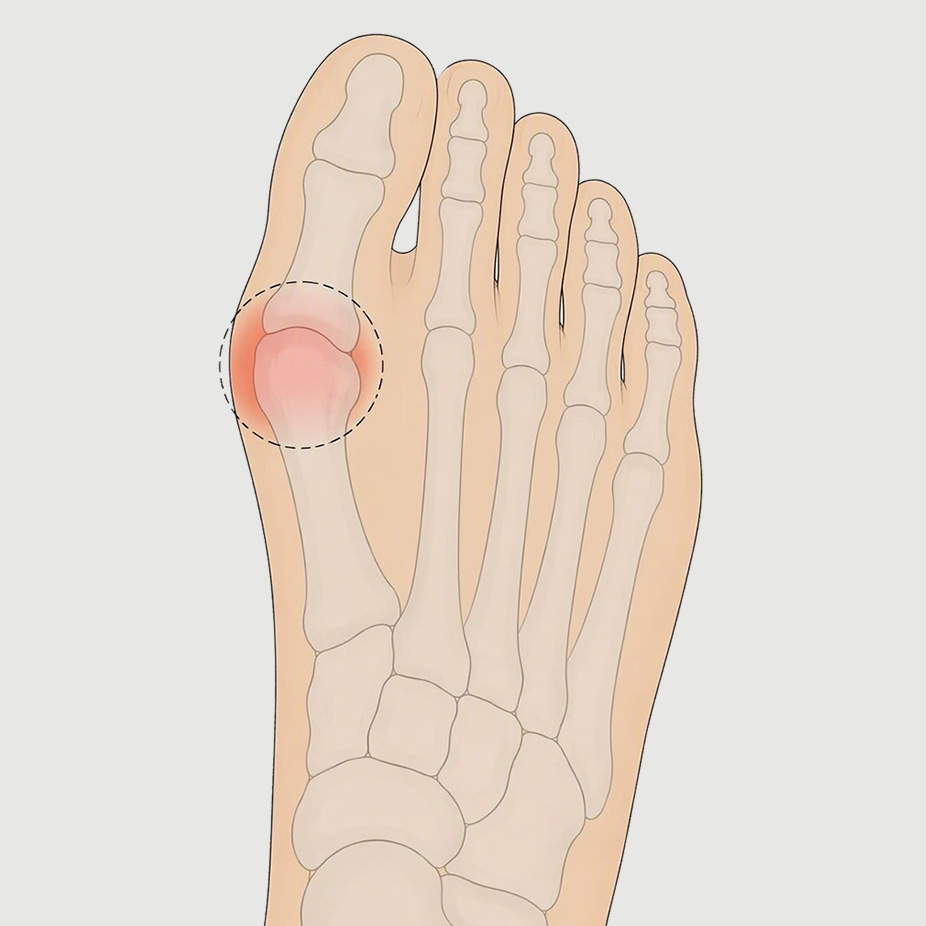 Big toe pain Square