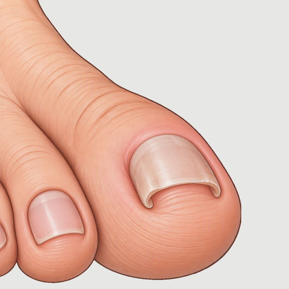 inverted nail Square