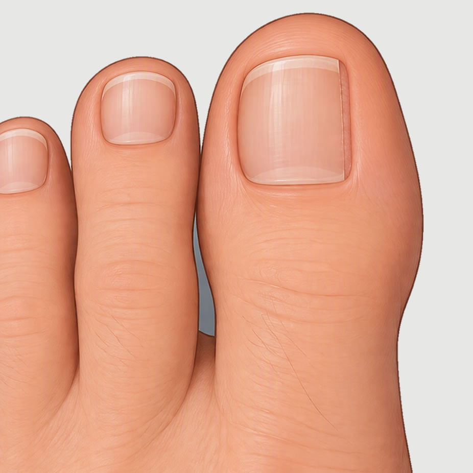 partial nail removal