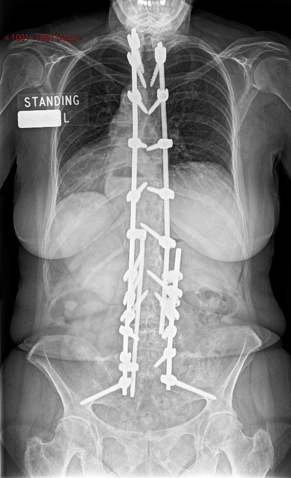 Spinal x-ray