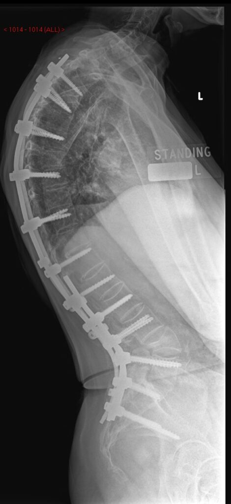 Spinal x-ray
