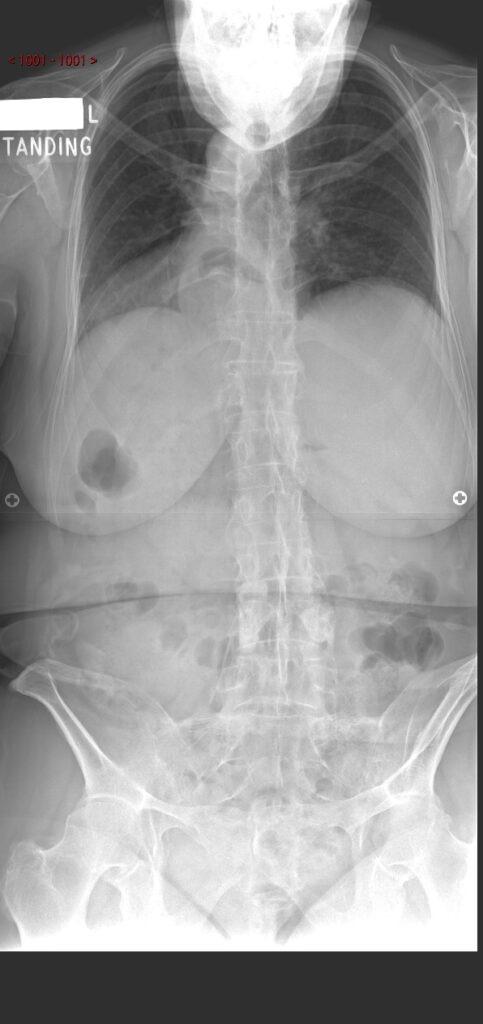 Spinal x-ray
