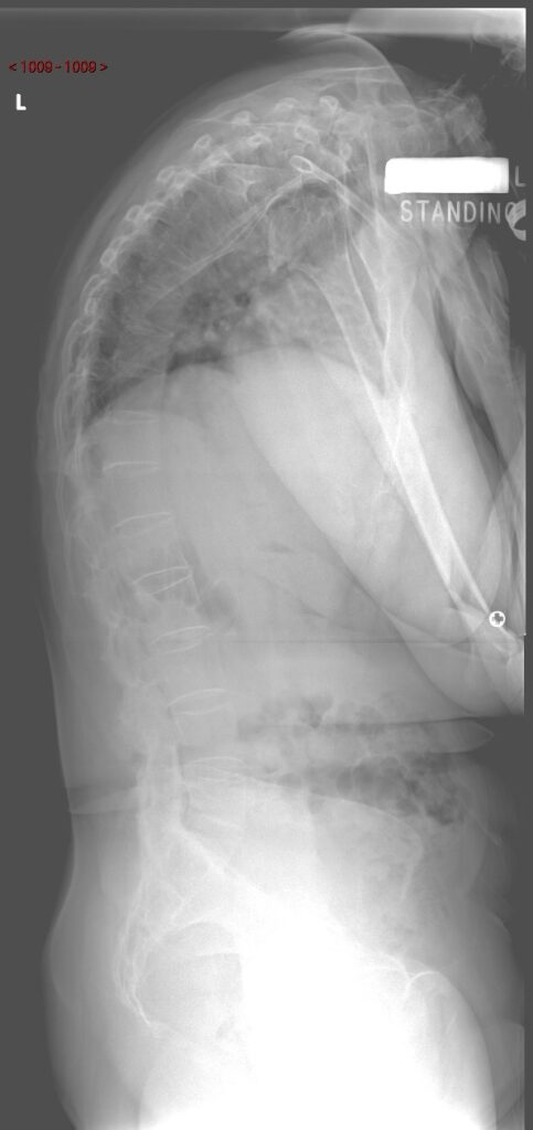 Spinal x-ray