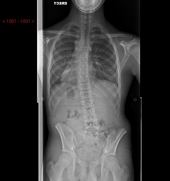 Spondylolisthesis – Scottish National Spine Service