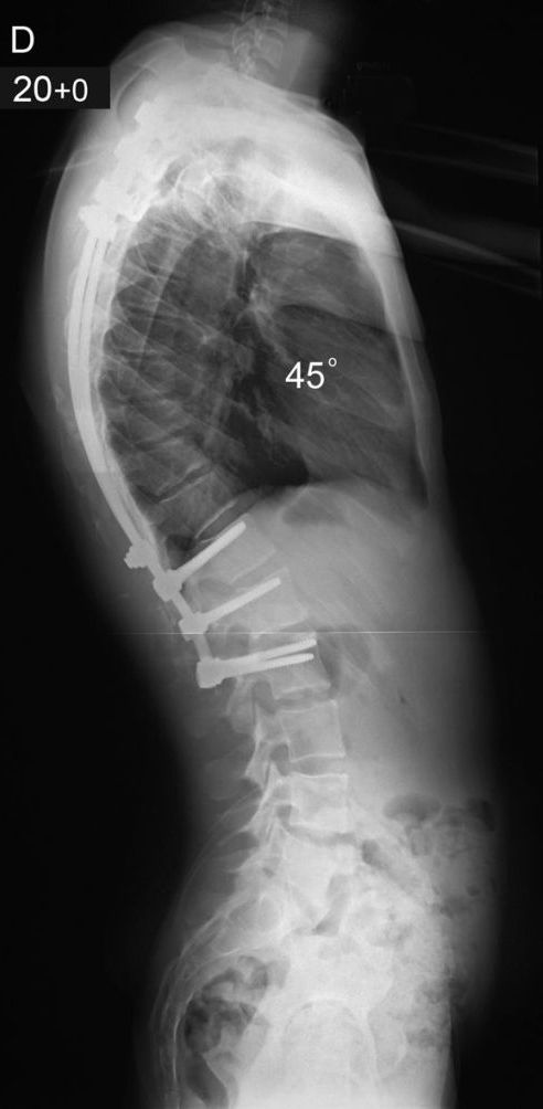 Scheuermann’s kyphosis – Scottish National Spine Service