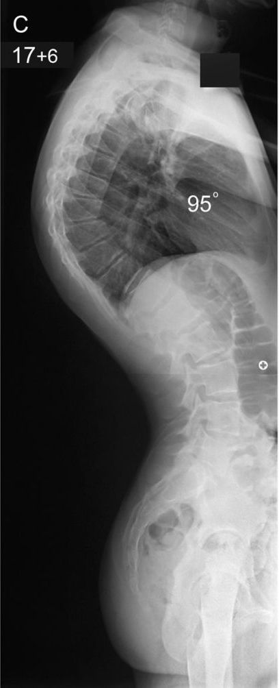 Scheuermann’s Kyphosis – Scottish National Spine Service