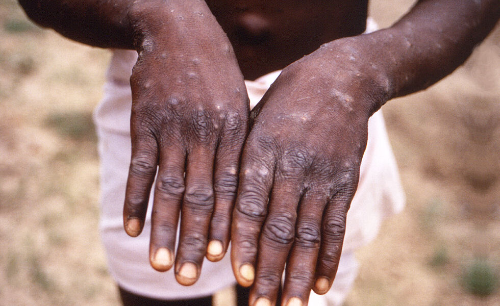 Dorsal surfaces of the hands of a mpox case patient